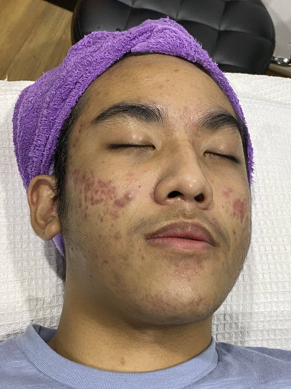 Santé beauté : Comment réduire l'acné ?